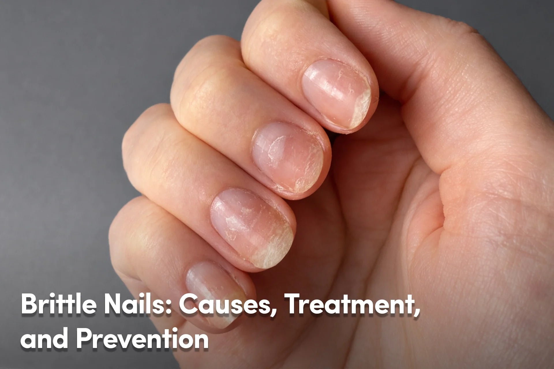 Brittle Nails: Causes, Treatment, and Prevention